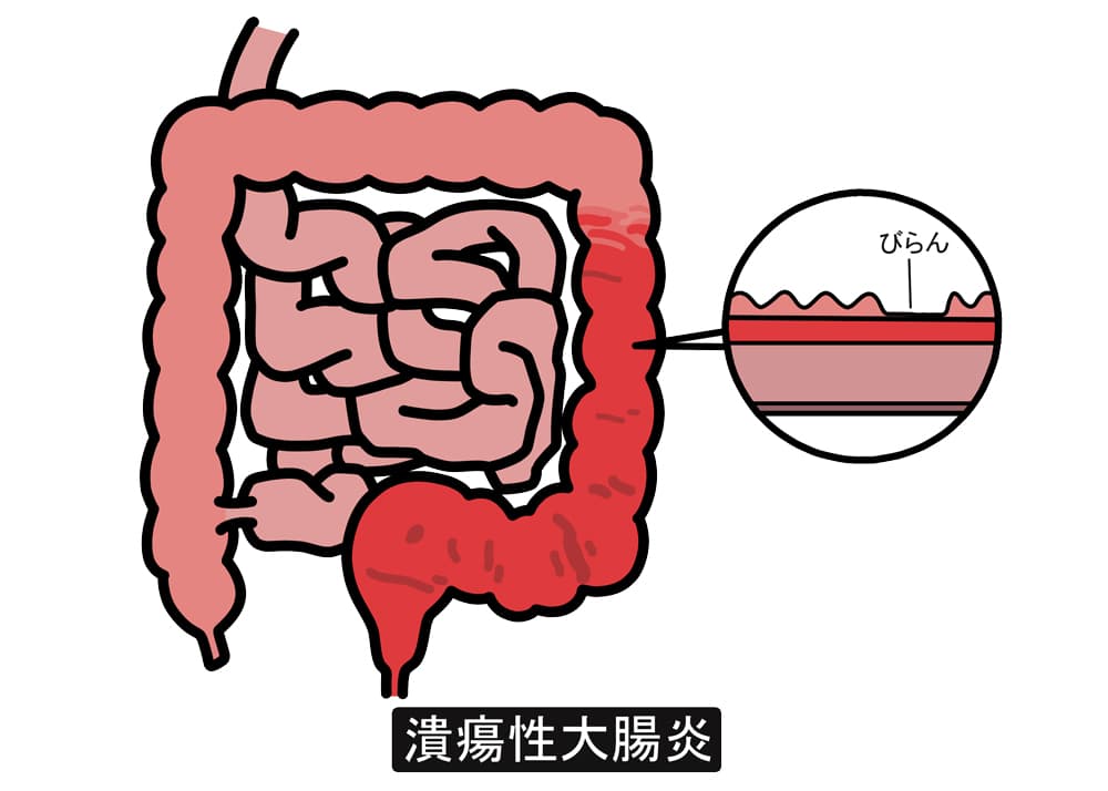 潰瘍性大腸炎